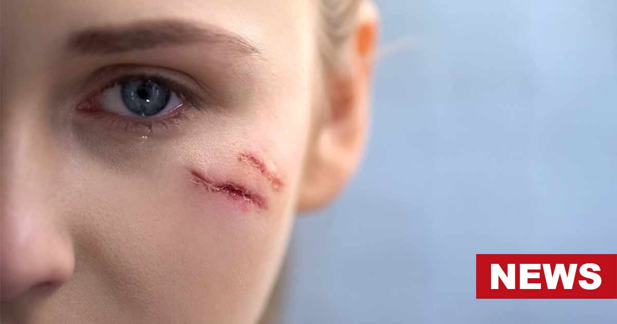 Research Reveals The Mental Health Effects Of Facial Scars 12 Research Reveals The Mental Health Effects Of Facial Scars